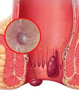 tratamiento hemorroides cancun